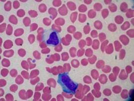 Infectious mononucleosis