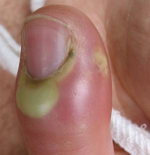 Painful Hangnail On Finger Iythealth Unfortunately It S Tempting To Bite Off The Hangnail Or Pluck Up Until Separates From Fingernail This Can Result In More Discomfort And Pain