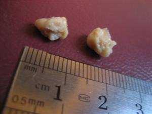 Tonsil stones or tonsilloliths