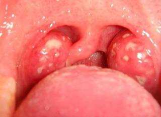 Tonsilitis