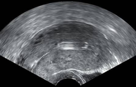 Ultrasound of the vagina