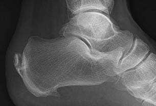 X-ray of a woman's foot