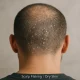 Close-up of a man’s buzzed scalp with visible dry, flaky skin on the crown — showing symptoms of dead skin buildup.