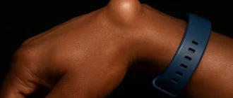 Subcutaneous wrist cyst on dark skin, non-surgical treatment example, ganglion cyst removal options.
