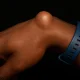 Subcutaneous wrist cyst on dark skin, non-surgical treatment example, ganglion cyst removal options.