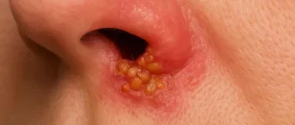 Close-up of nasal herpes (HSV-1) showing clustered blisters and inflammation around nostrils during an active outbreak phase.