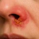Close-up of nasal herpes (HSV-1) showing clustered blisters and inflammation around nostrils during an active outbreak phase.