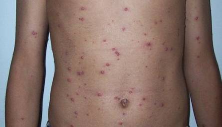 Can You Get Herpes On Stomach Health Advisor