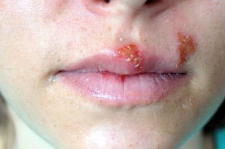 Herpes on the lip and around the nose