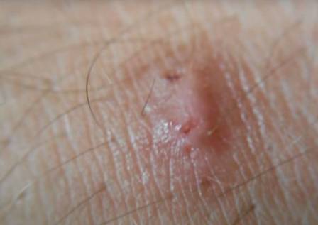 Wart on elbow