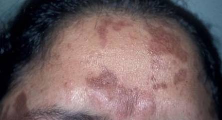 Pigmentation on a forehead