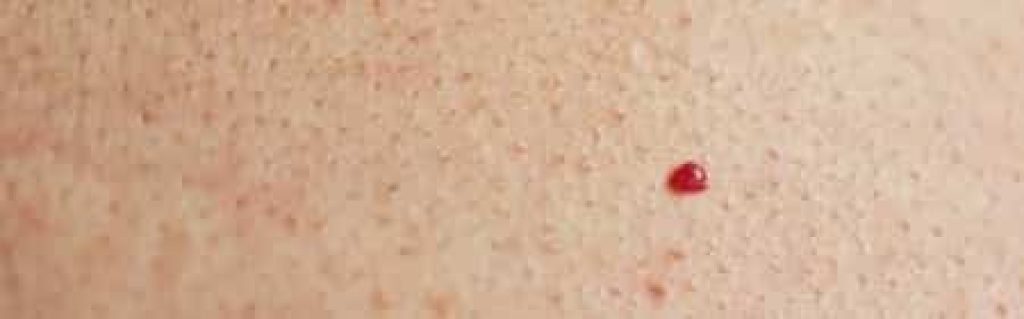 what-those-tiny-red-dots-on-your-skin-might-mean-scary-symptoms