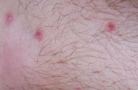 colchicine pinpoint red spots on skin