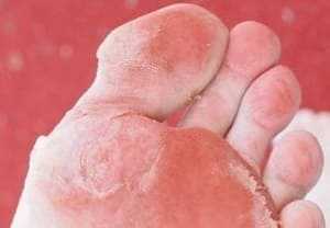 skin feet dead excessive excess aspects develop environmental either reasons due medical