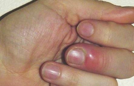 How to cure a hangnail pain