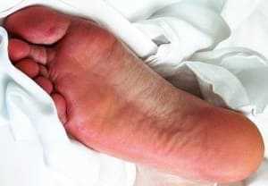 What causes excessive dead skin on feet