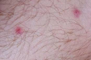 Tiny Red Dots on Skin - Health Advisor