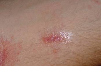 Tiny Red Dots on Skin - Health Advisor