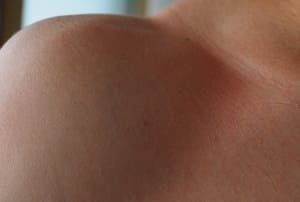 Sunburn of shoulder