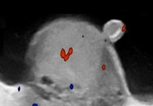 Scrotal ultrasonography with Doppler