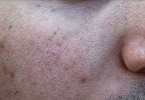 What causes pockmarks on face