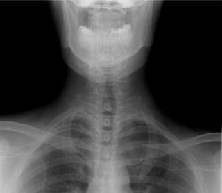Throat X-ray analysis