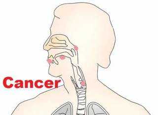 Throat cancer and esophageal cancer