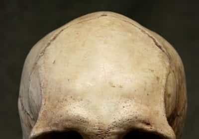 Skull ridges in adults