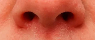 Close-up of nose skin with visible dryness, redness, and flaking, highlighting itchy and irritated skin on the nose.