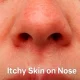 Close-up of nose skin with visible dryness, redness, and flaking, highlighting itchy and irritated skin on the nose.