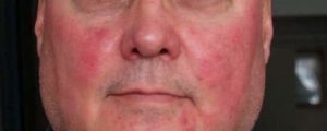 Causes of Flushed Face - Health Advisor