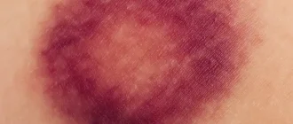 Close-up of a dark red and purple bruise on human skin, showing uneven edges and healing color changes without revealing the body part.