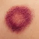 Close-up of a dark red and purple bruise on human skin, showing uneven edges and healing color changes without revealing the body part.
