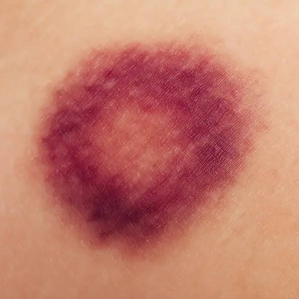 Close-up of a dark red and purple bruise on human skin, showing uneven edges and healing color changes without revealing the body part.