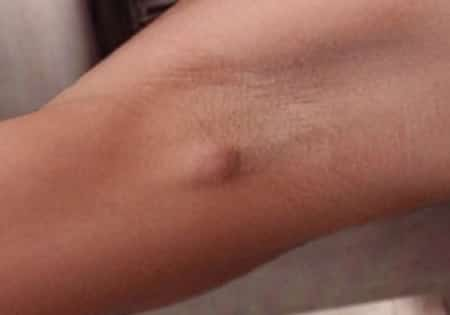 bumps on armpit in woman