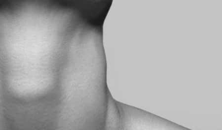 swollen lymph node back of neck