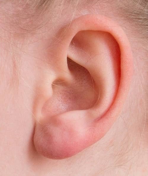 dry skin in ear canal