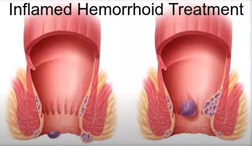 Inflamed Hemorrhoid Treatment