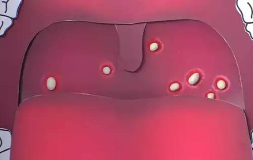 Staphylococcus aureus in the throat - image template