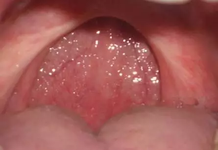 piece of popcorn stuck in throat