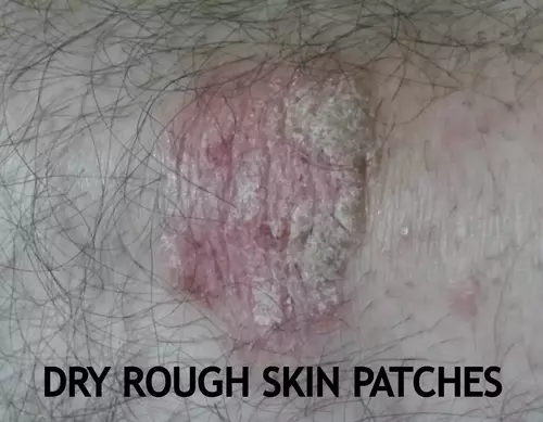 dry rough skin patches