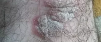 dry rough patch on skin