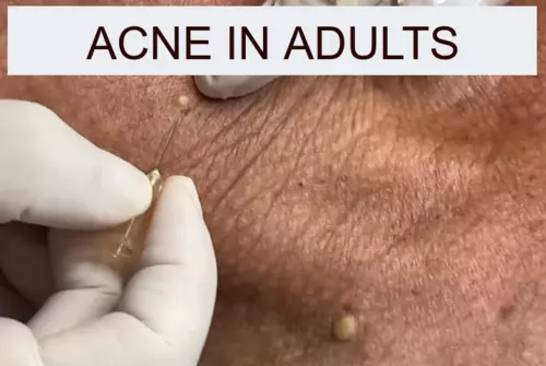 acne in adults