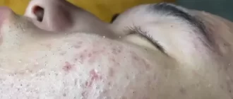 Blackheads on a Face before removal procedure