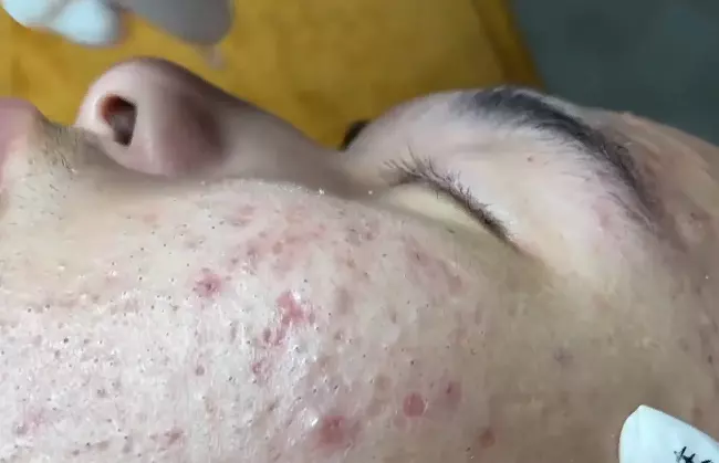 Blackheads on a Face before removal procedure