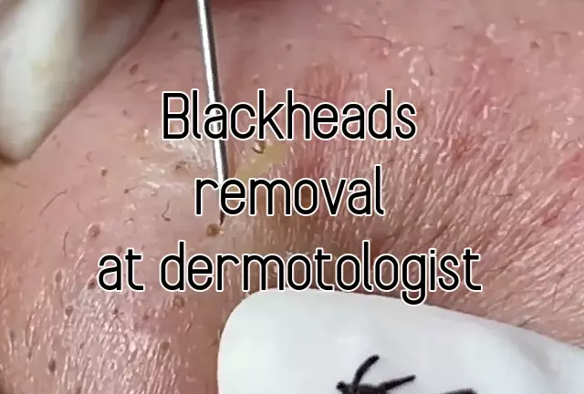 Blackheads on a Face Removing Session