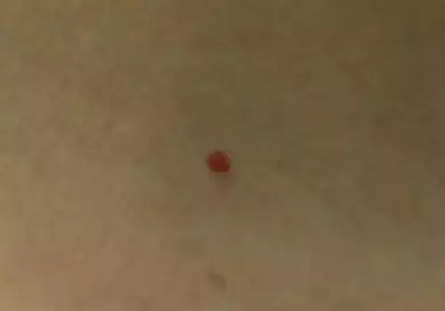 Small Raised Dots on Skin removal