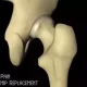 Groin Pain After Hip Replacement