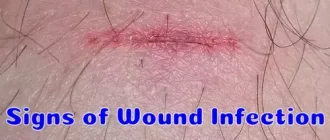Signs of Wound Infection