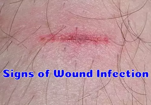 Signs of Wound Infection